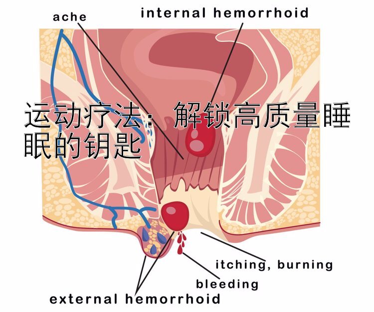 运动疗法：解锁高质量睡眠的钥匙