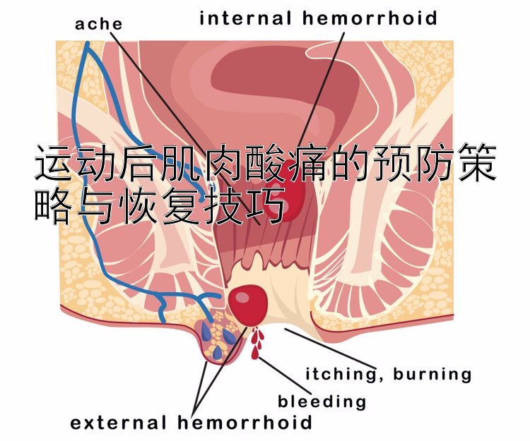 运动后肌肉酸痛的预防策略与恢复技巧