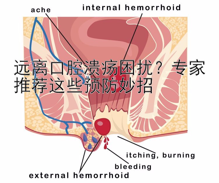 远离口腔溃疡困扰？专家推荐这些预防妙招